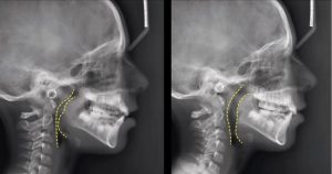Функциональная ортодонтия:  более чем просто ровные зубы