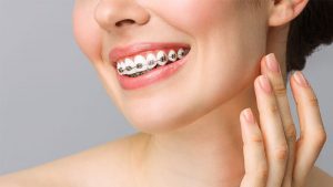 Брекеты под ключ: комплексное решение для красивой улыбки